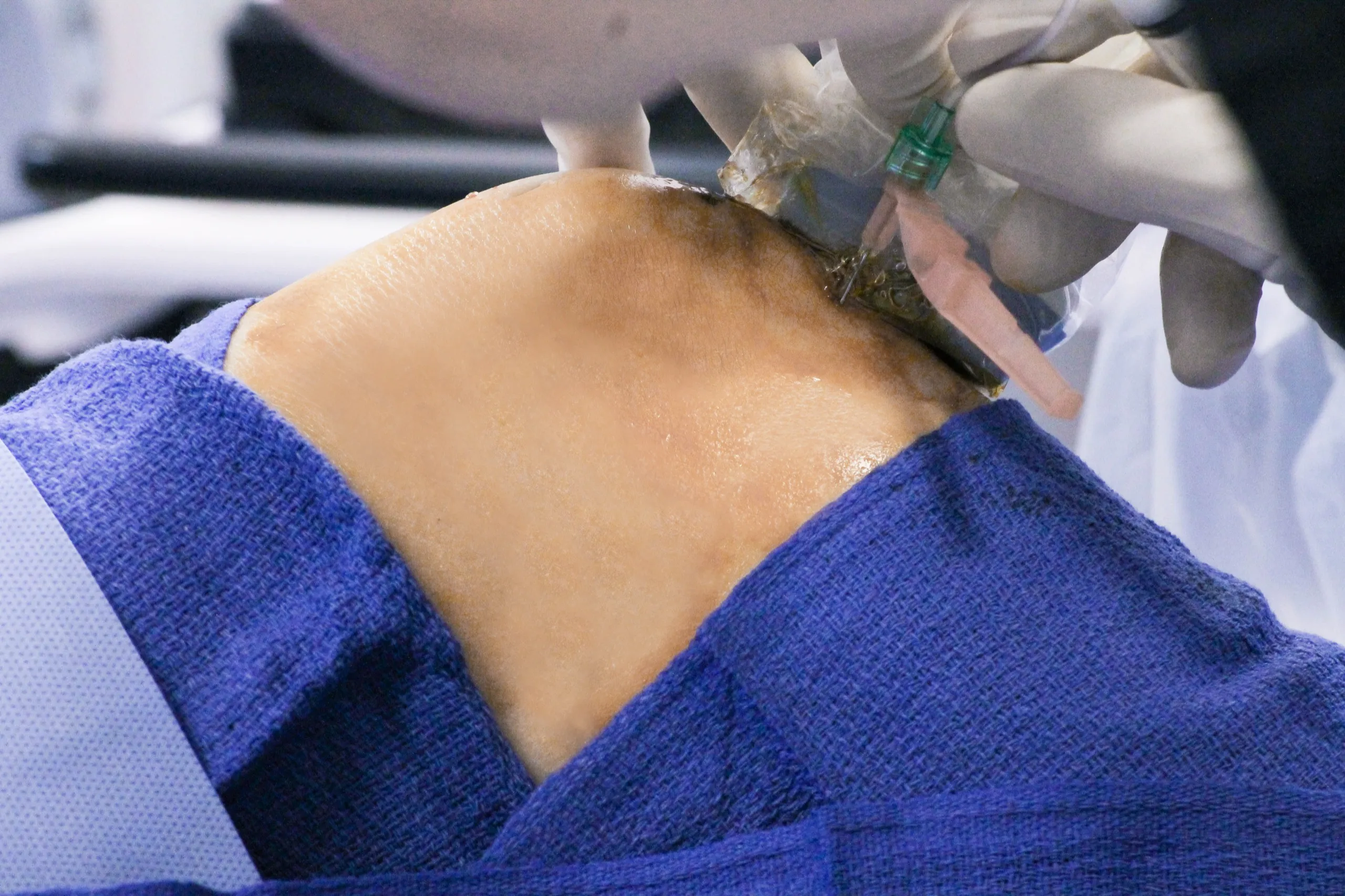 Preparing platelet-rich plasma in the clinic laboratory