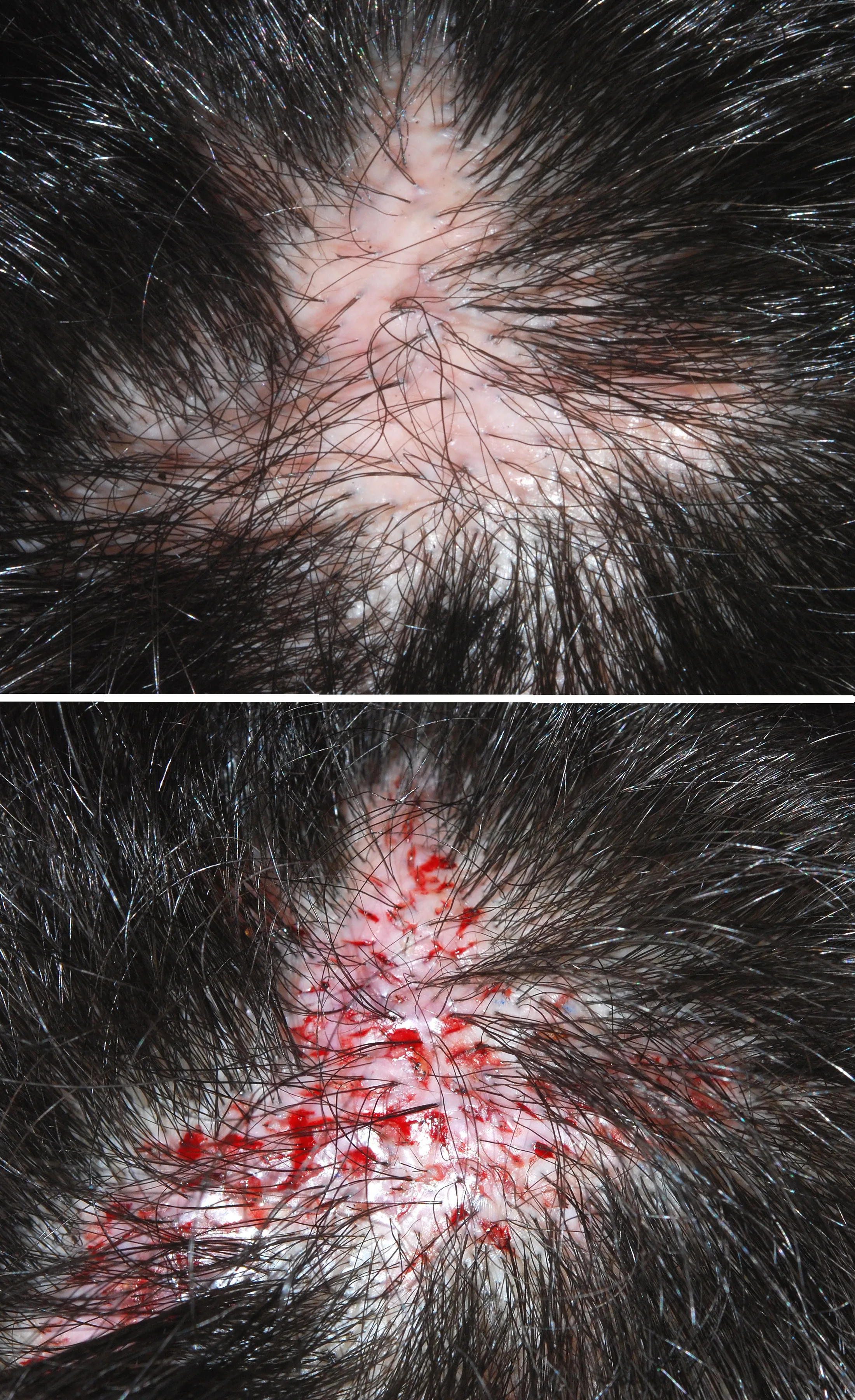 FUE Transplant