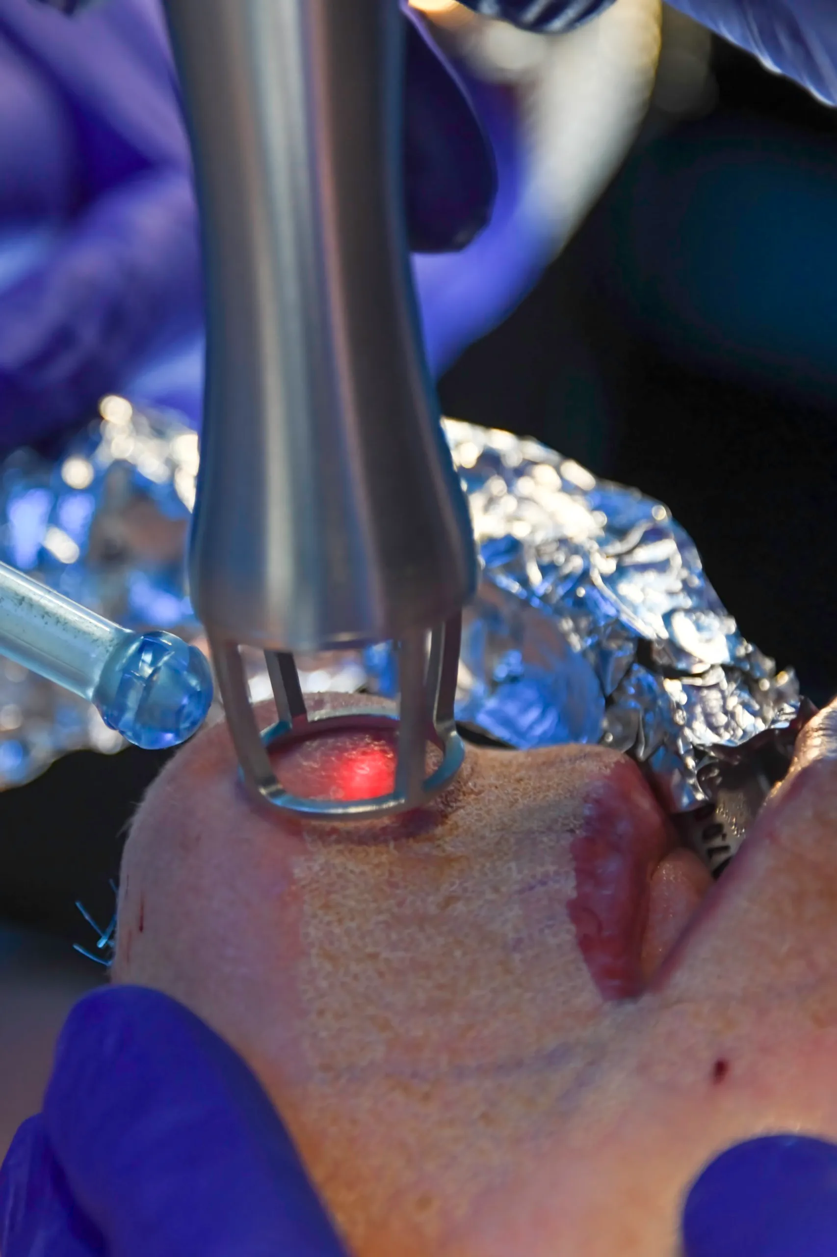 Laser Therapy