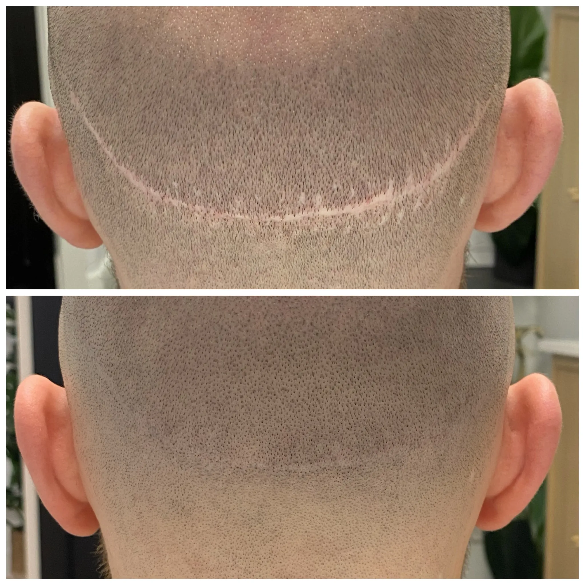 Scar Transplant